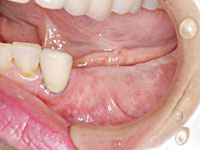 骨造成後の写真