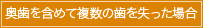 	奥歯を含めて複数の歯を失った場合