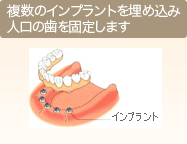 複数のインプラントを埋め込み人口の歯を固定します