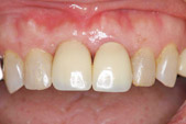 審美的インプラント治療