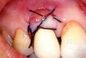 歯周補綴